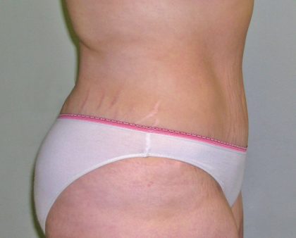 Tummy Tuck Before & After Patient #394