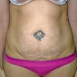 Tummy Tuck Before & After Patient #401