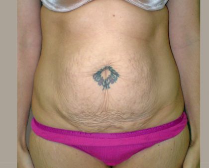 Tummy Tuck Before & After Patient #401