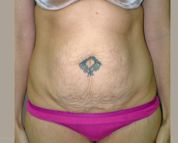 Tummy Tuck Before & After Patient #401
