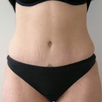 Tummy Tuck Before & After Patient #401