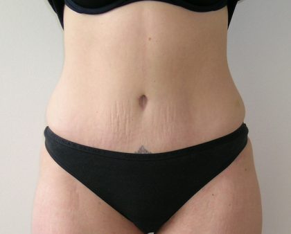 Tummy Tuck Before & After Patient #401