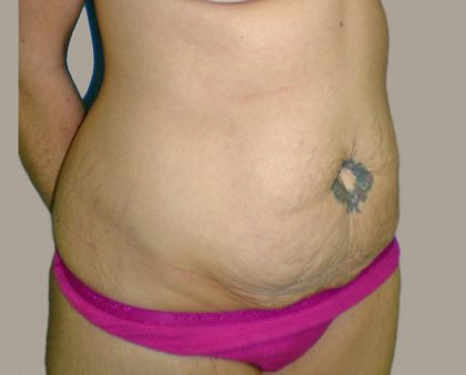 Tummy Tuck Before & After Patient #401