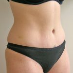 Tummy Tuck Before & After Patient #401