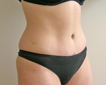 Tummy Tuck Before & After Patient #401