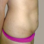 Tummy Tuck Before & After Patient #401