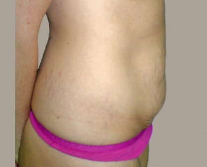 Tummy Tuck Before & After Patient #401