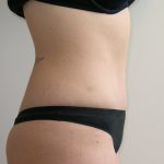 Tummy Tuck Before & After Patient #401