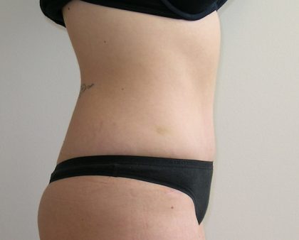 Tummy Tuck Before & After Patient #401