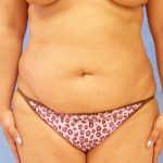 Tummy Tuck Before & After Patient #417