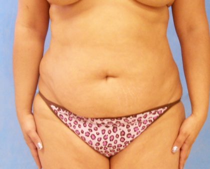 Tummy Tuck Before & After Patient #417