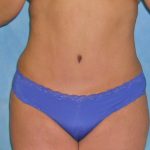 Tummy Tuck Before & After Patient #417