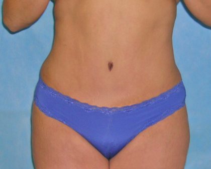 Tummy Tuck Before & After Patient #417