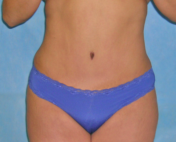 Tummy Tuck Before & After Patient #417