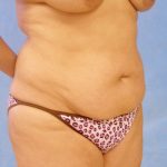 Tummy Tuck Before & After Patient #417