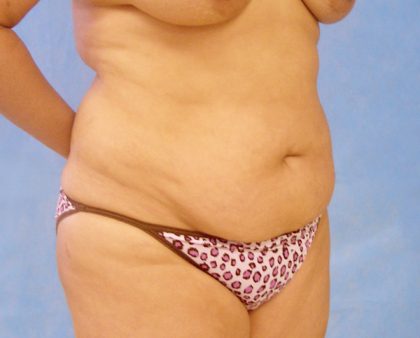 Tummy Tuck Before & After Patient #417