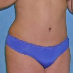 Tummy Tuck Before & After Patient #417