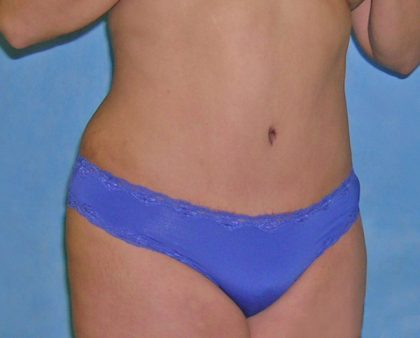 Tummy Tuck Before & After Patient #417