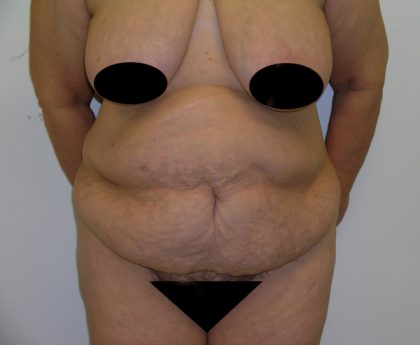 Tummy Tuck Before & After Patient #470