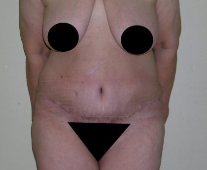 Tummy Tuck Before & After Patient #470