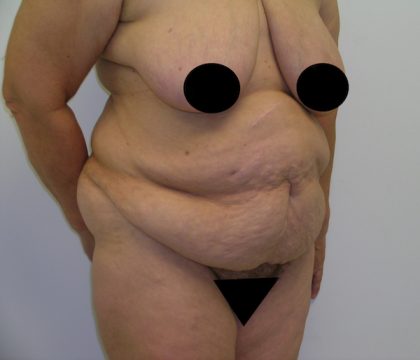 Tummy Tuck Before & After Patient #470