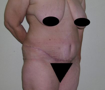 Tummy Tuck Before & After Patient #470