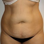 Tummy Tuck Before & After Patient #408