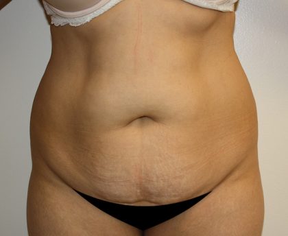 Tummy Tuck Before & After Patient #408