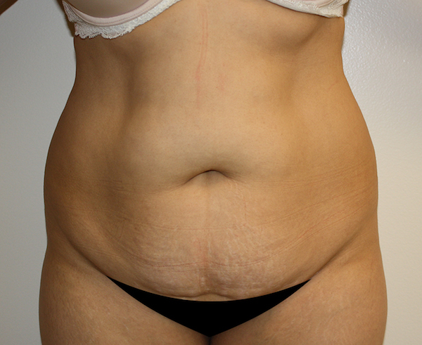 Tummy Tuck Before & After Patient #408