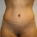 Tummy Tuck Before & After Patient #408