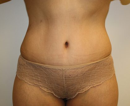 Tummy Tuck Before & After Patient #408