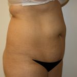 Tummy Tuck Before & After Patient #408