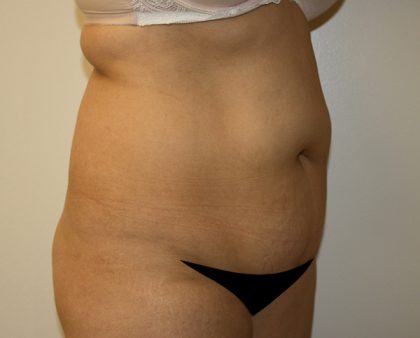 Tummy Tuck Before & After Patient #408