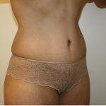 Tummy Tuck Before & After Patient #408