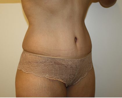 Tummy Tuck Before & After Patient #408