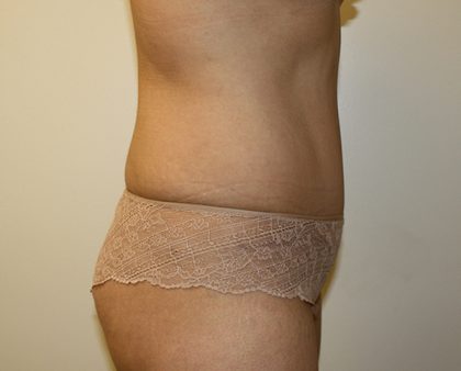 Tummy Tuck Before & After Patient #408