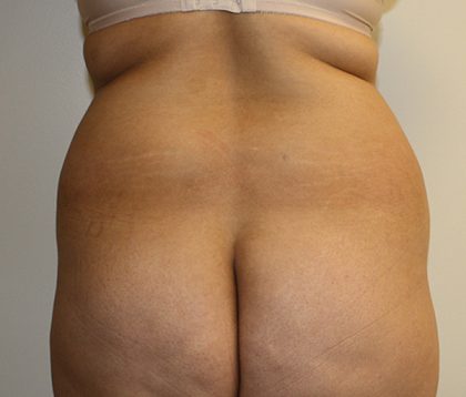 Tummy Tuck Before & After Patient #408