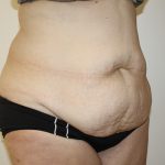 Tummy Tuck Before & After Patient #361