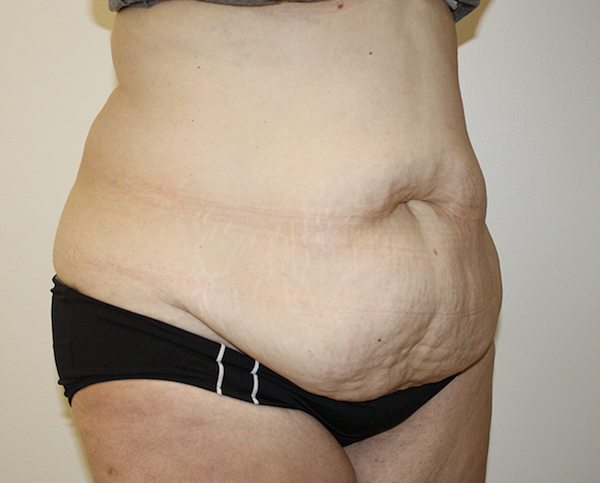 Major Weight Loss Tummy Tuck Before & After Patient #361