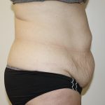 Tummy Tuck Before & After Patient #361