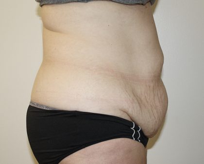 Tummy Tuck Before & After Patient #361