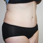 Tummy Tuck Before & After Patient #361