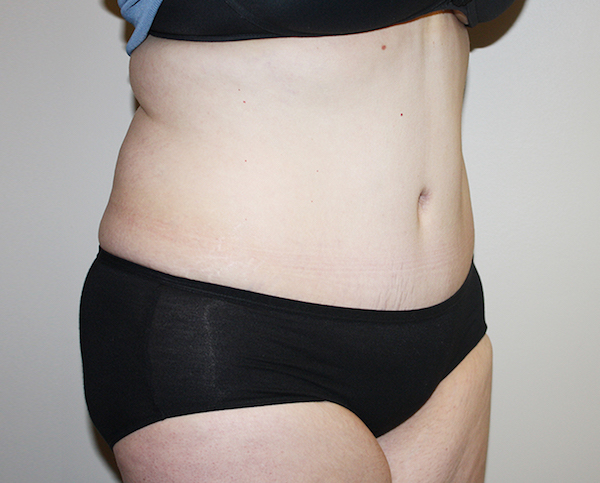 Major Weight Loss Tummy Tuck Before & After Patient #361