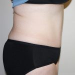 Tummy Tuck Before & After Patient #361