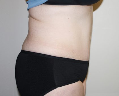 Tummy Tuck Before & After Patient #361