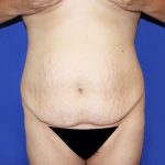 Tummy Tuck Before & After Patient #463