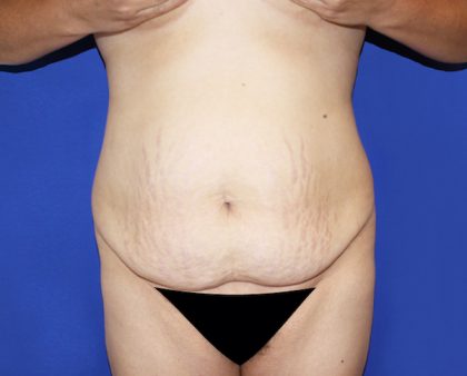 Tummy Tuck Before & After Patient #463