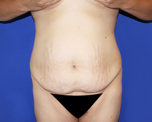 Tummy Tuck Before & After Patient #463