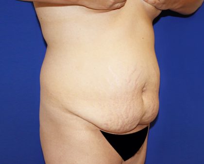 Tummy Tuck Before & After Patient #463