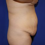 Tummy Tuck Before & After Patient #463